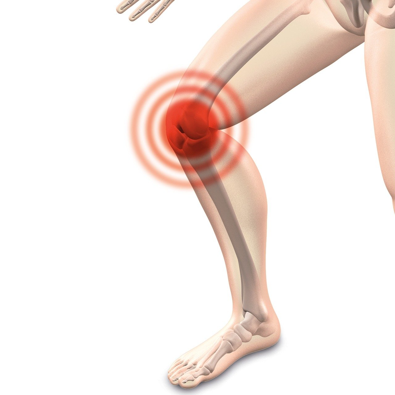 Các tiêu chí phục hồi chức năng sau chấn thương Sụn chêm (Meniscus Injury) + Dây chằng chéo trước (ACL Reconstruction – ACLR) đối với một cầu thủ bóng đá
