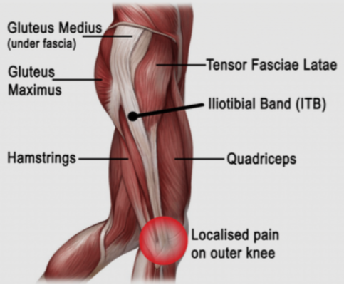 Làm sao để quay lại thi đấu sau khi bị Hội chứng Dải Chậu Chày (IT Band Syndrome)?